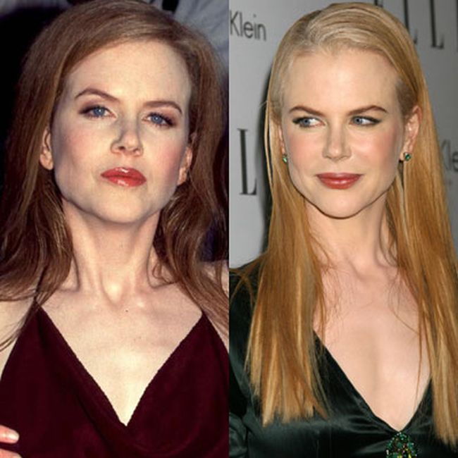 Nicole Kidman Plastic Surgery Photos Before Amp After Surgery4